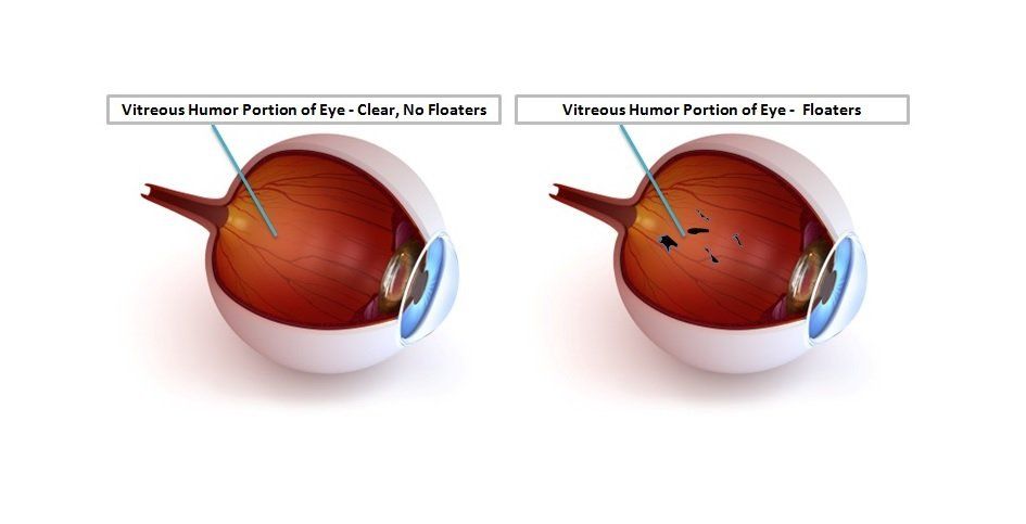 Eye Floaters